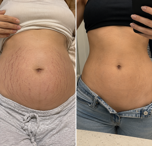 SpatGlow Anti-Stretch Mark Micro-Infusion