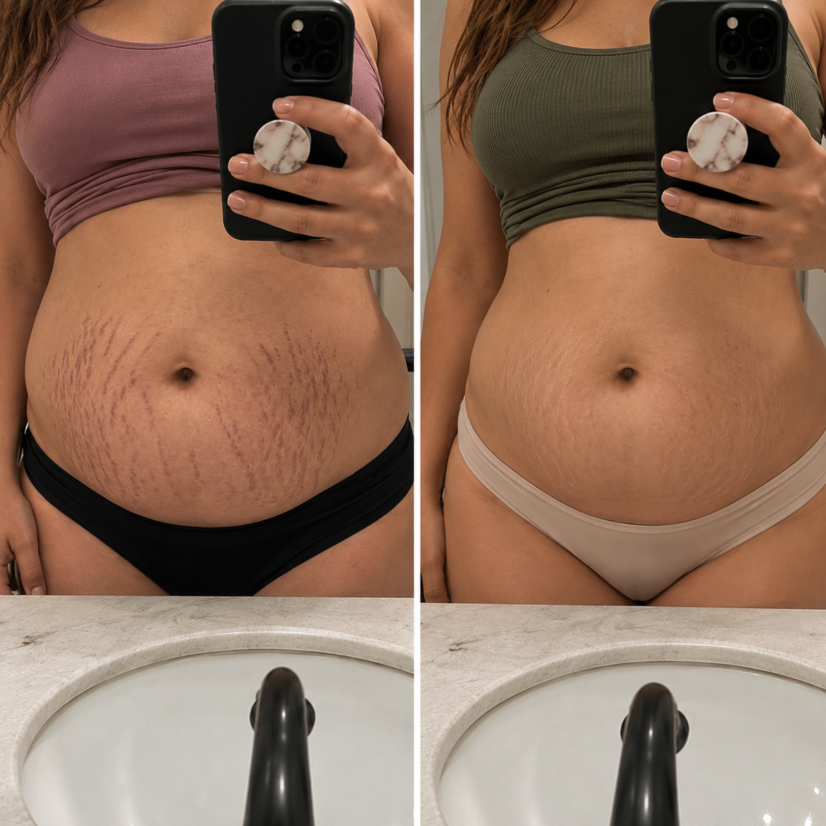 SpatGlow Anti-Stretch Mark Micro-Infusion